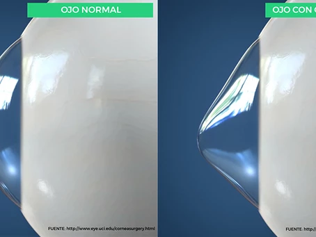 ¿Qué es el Queratocono?